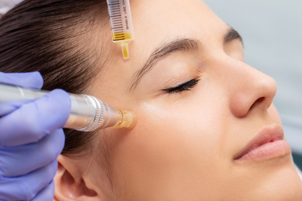 PRP Microneedling